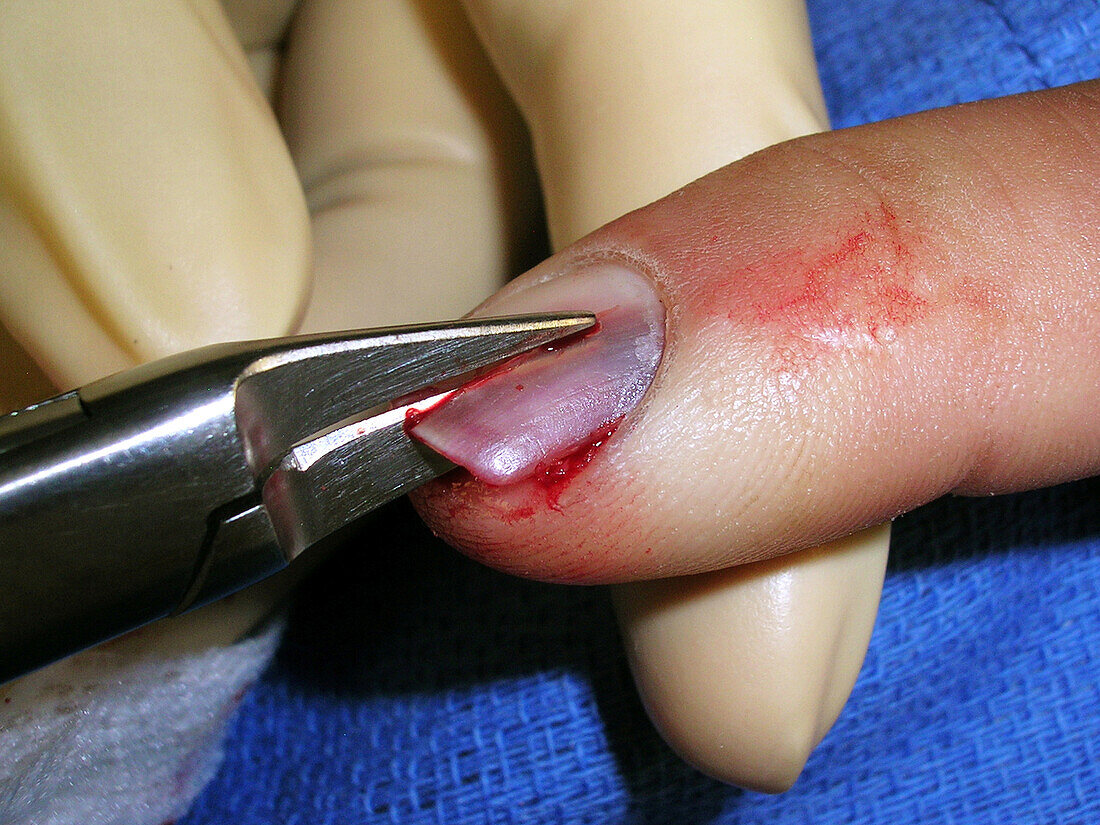 Biopsy of discoloured nail