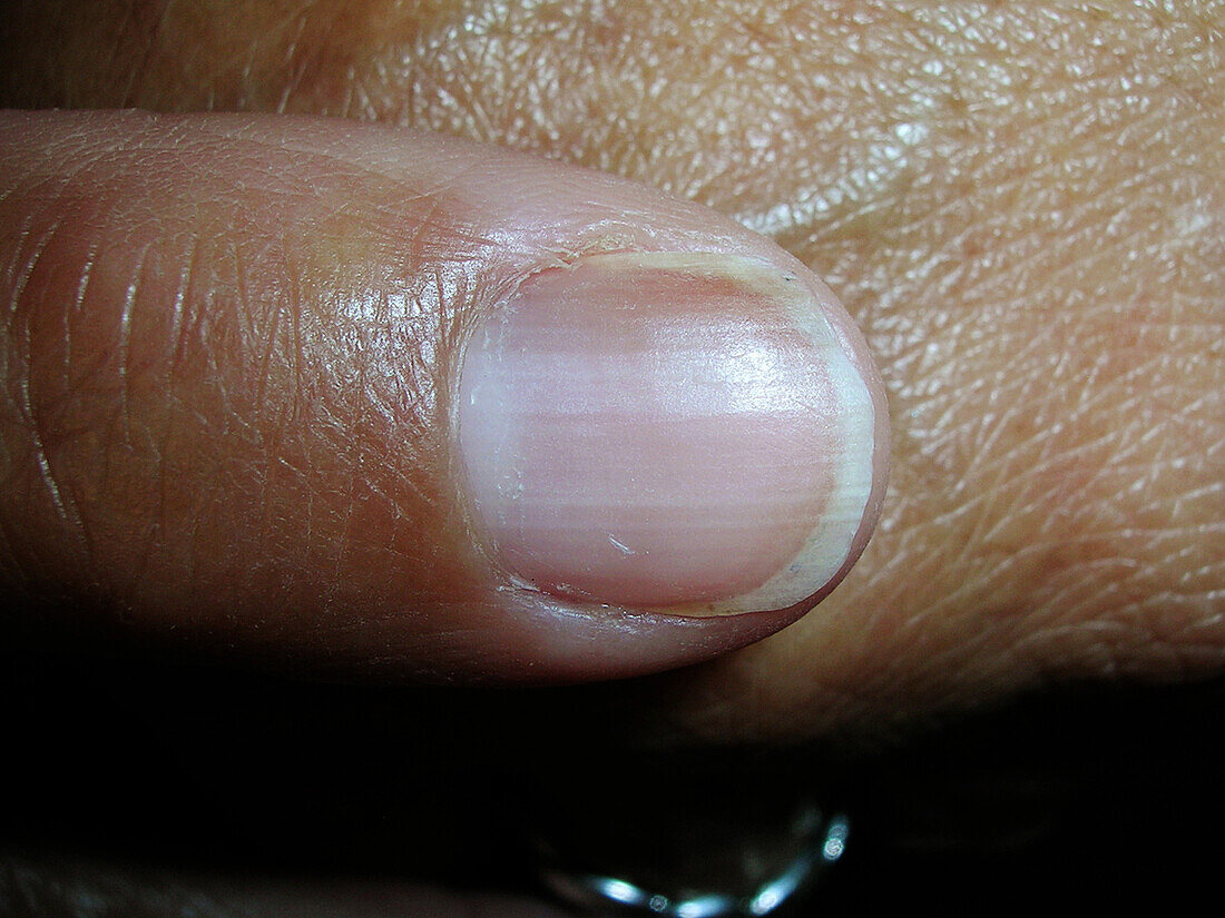 Discoloured nail