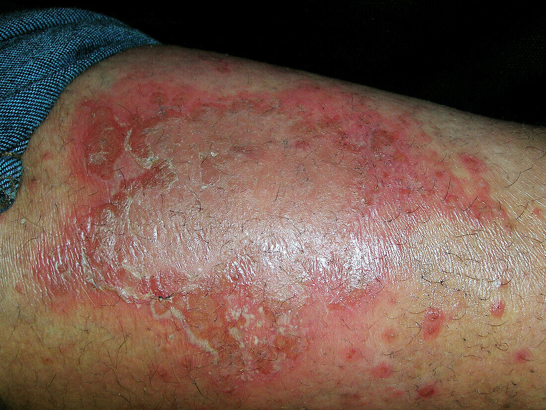 Pustular psoriasis