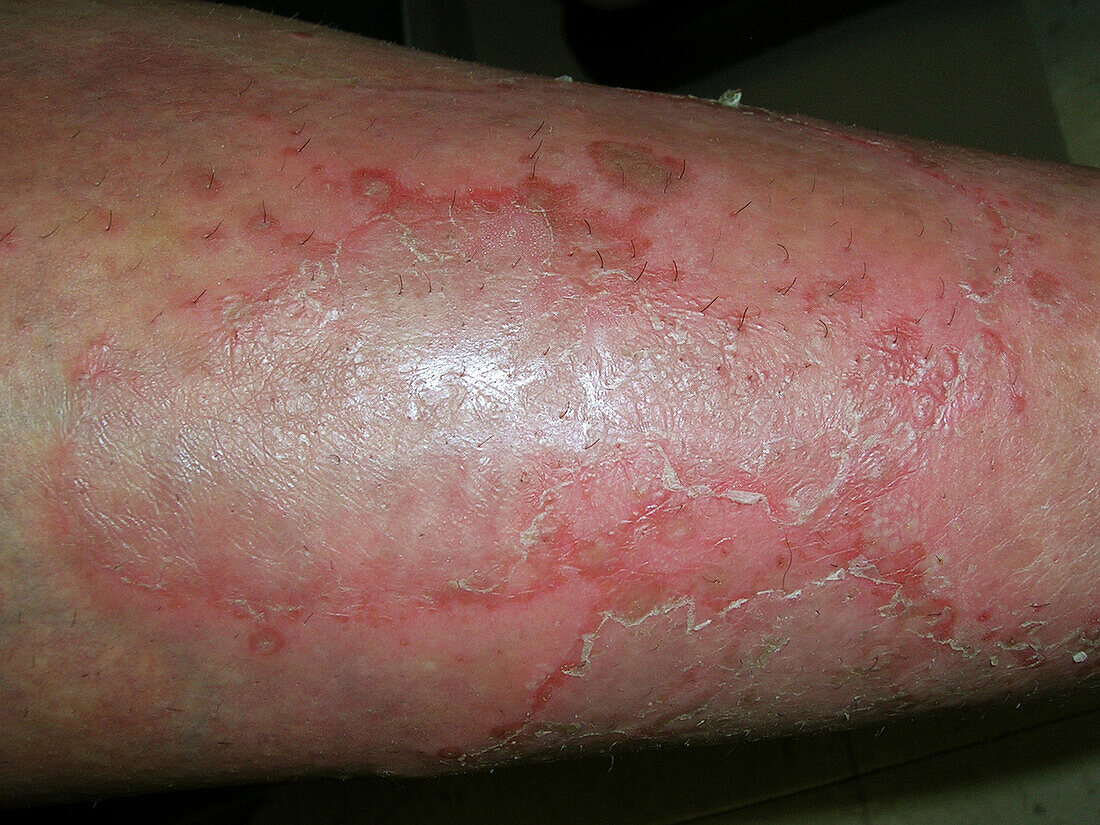 Pustular psoriasis