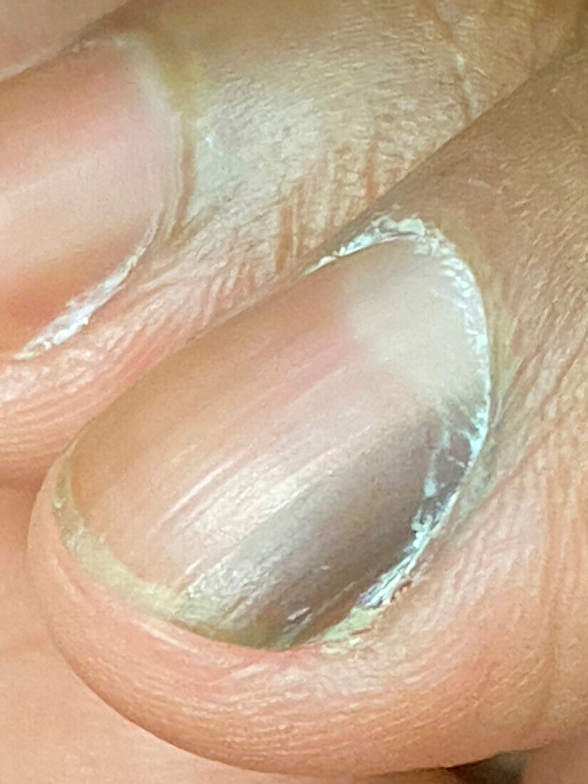 Discoloured nail