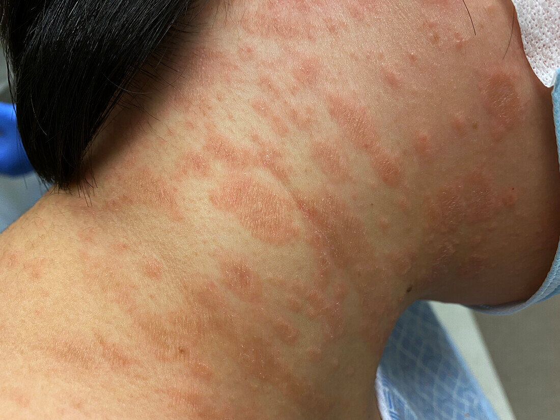 Pityriasis rosea rash