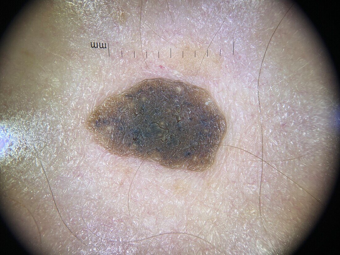 Seborrheic keratosis, dermoscopy