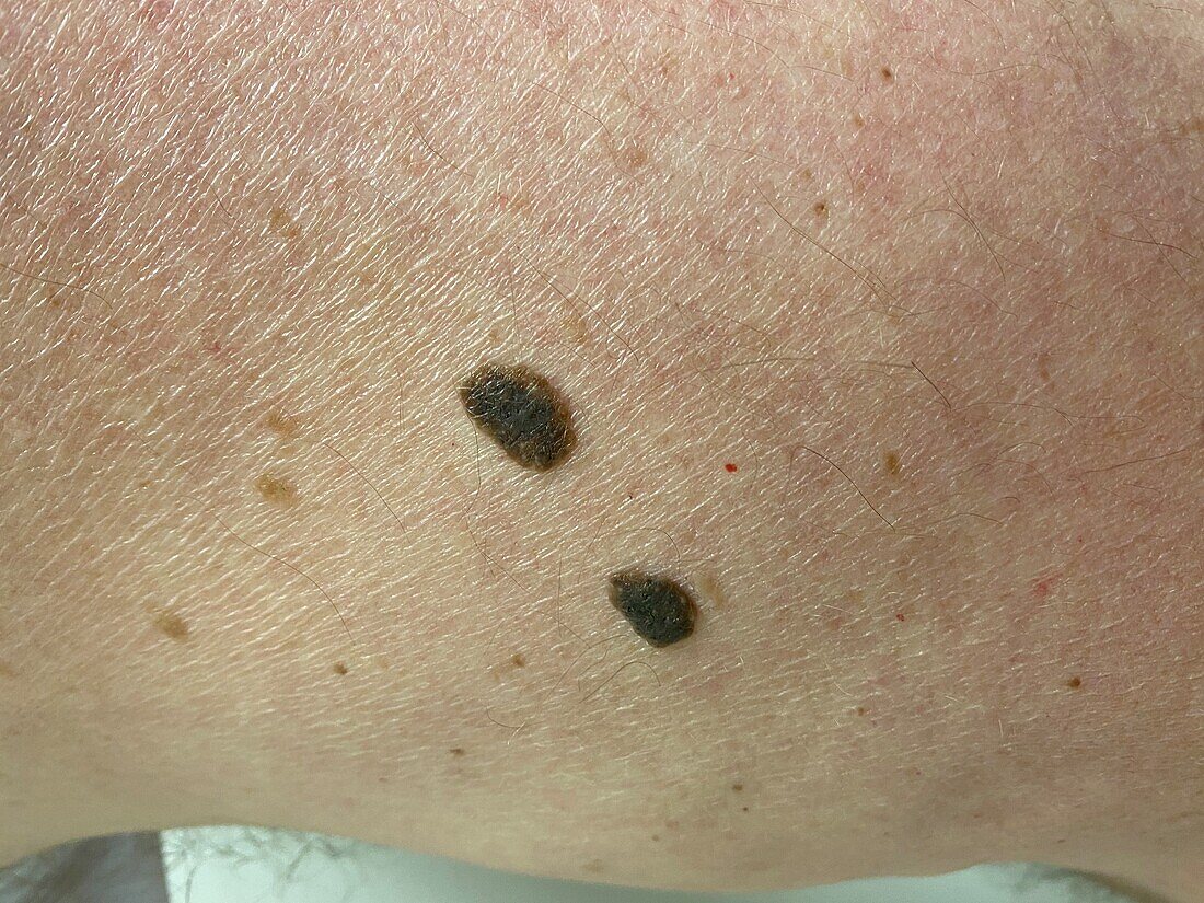 Seborrheic keratosis