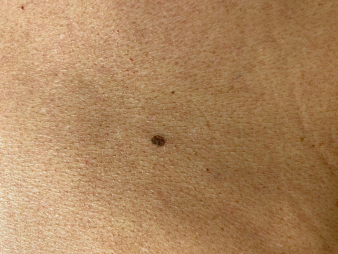 Seborrheic keratosis