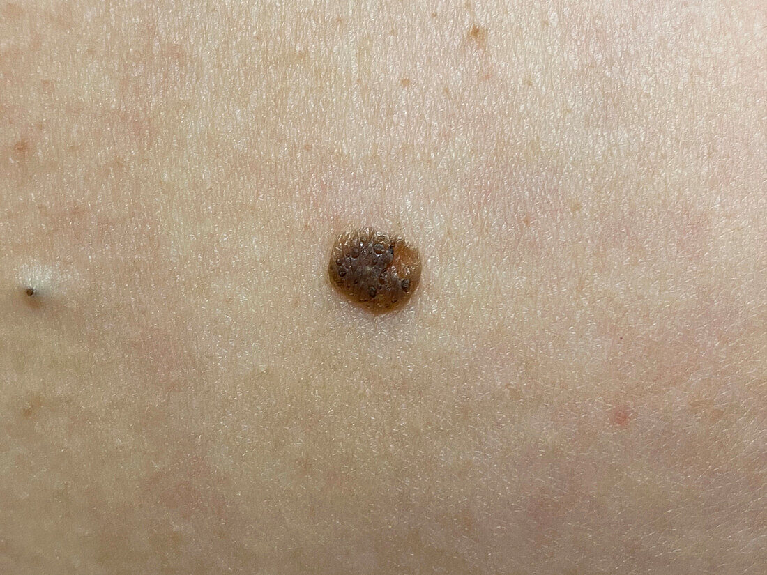 Seborrheic keratosis