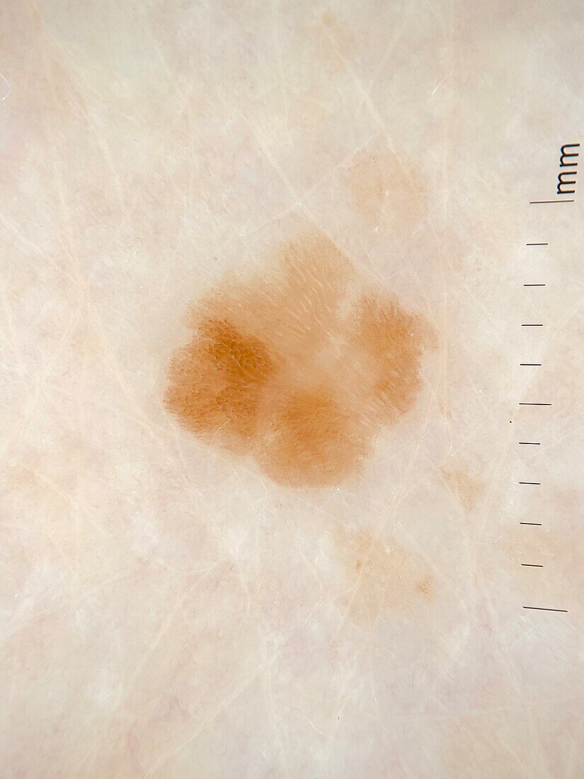 Seborrheic keratosis, dermoscopy