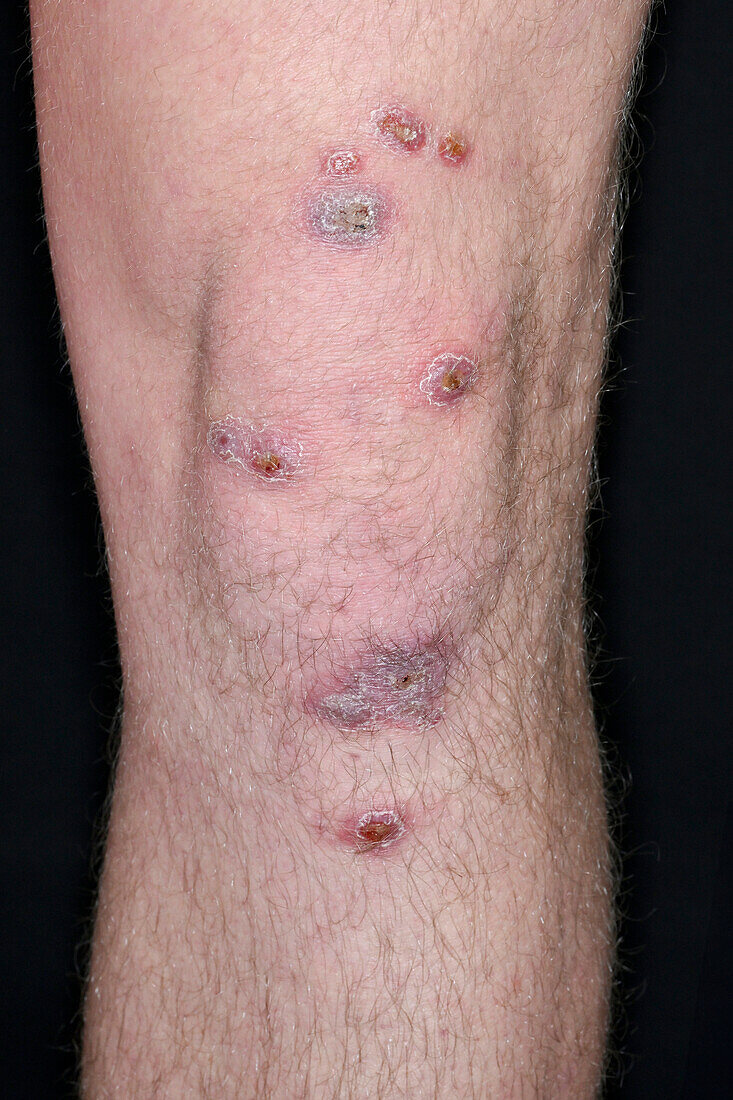 Impetigo lesions on a mans leg