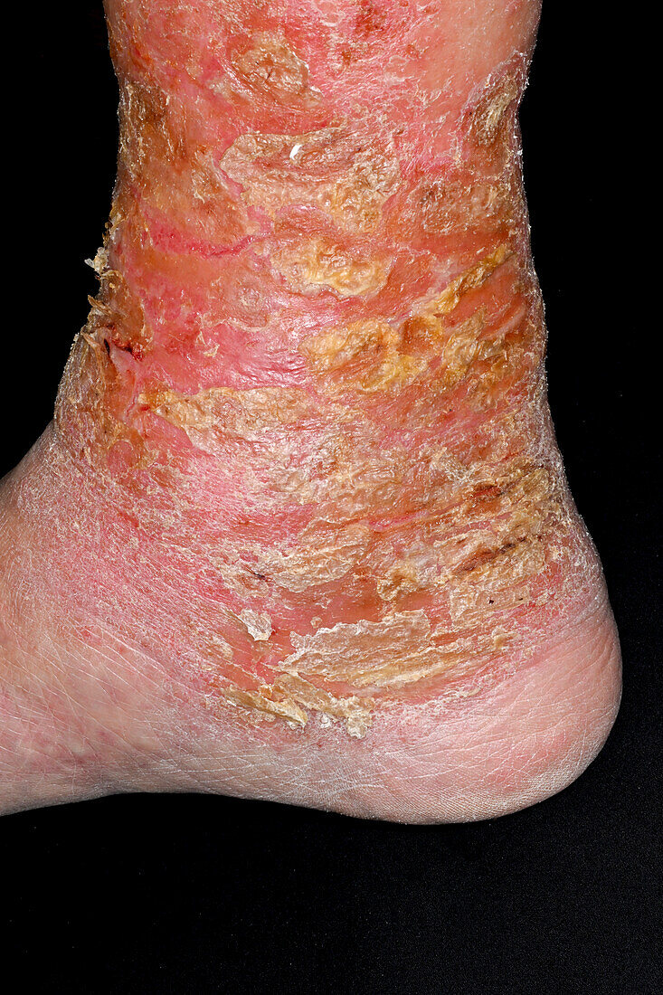 Varicose eczema on a man's ankle