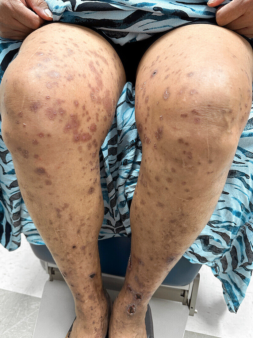 IgA vasculitis