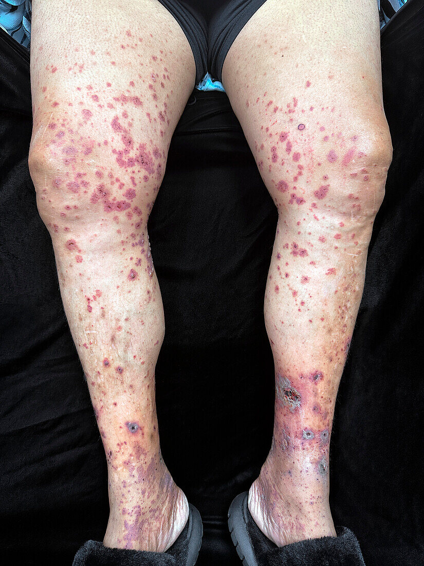 IgA vasculitis