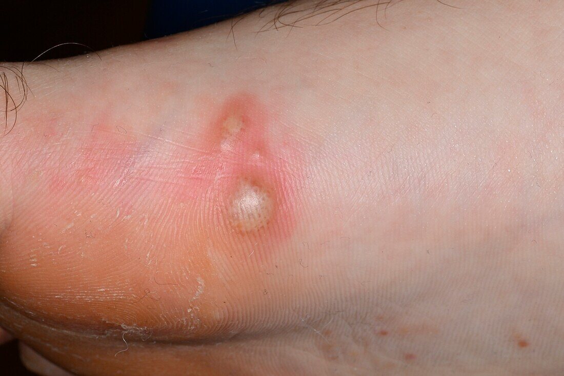 Pompholyx on a man's foot