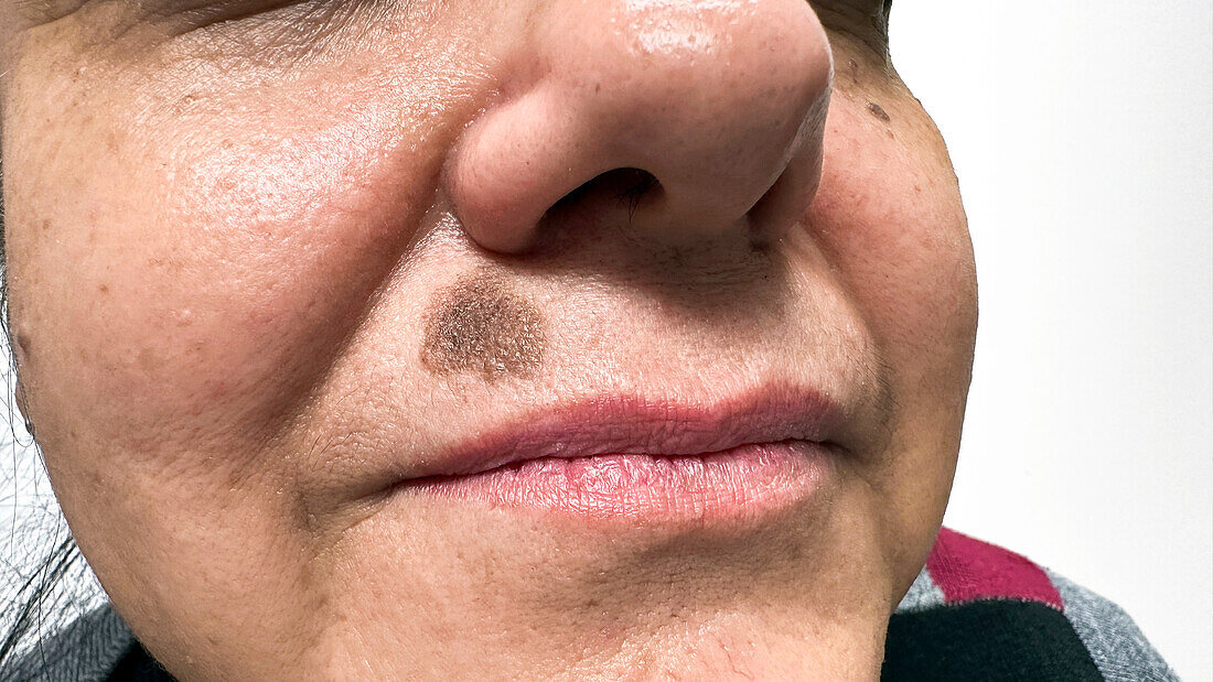 Seborrheic keratosis