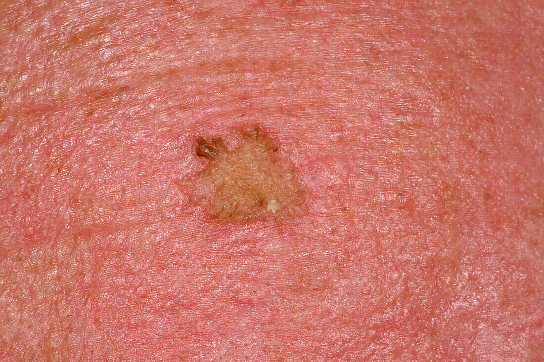 Solar keratosis on a man's scalp