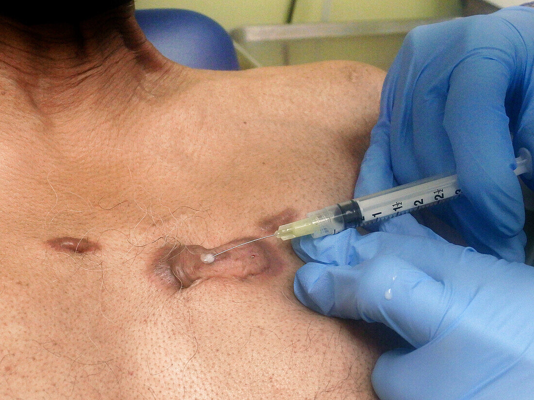 Intralesional injection of keloid scar