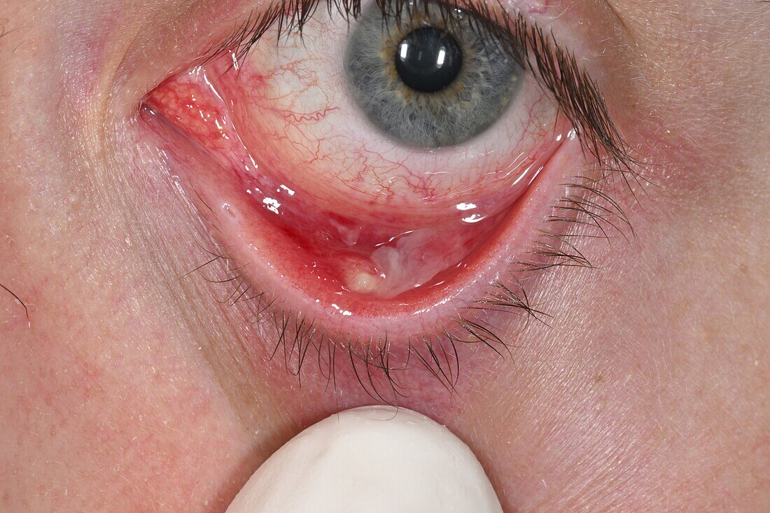 Ruptured chalazion cyst on a woman's lower eyelid