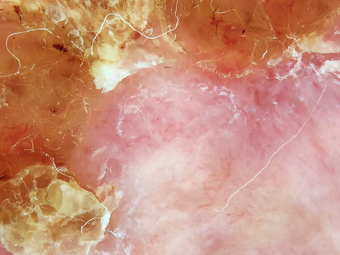 Treatment of actinic keratosis, dermoscopy