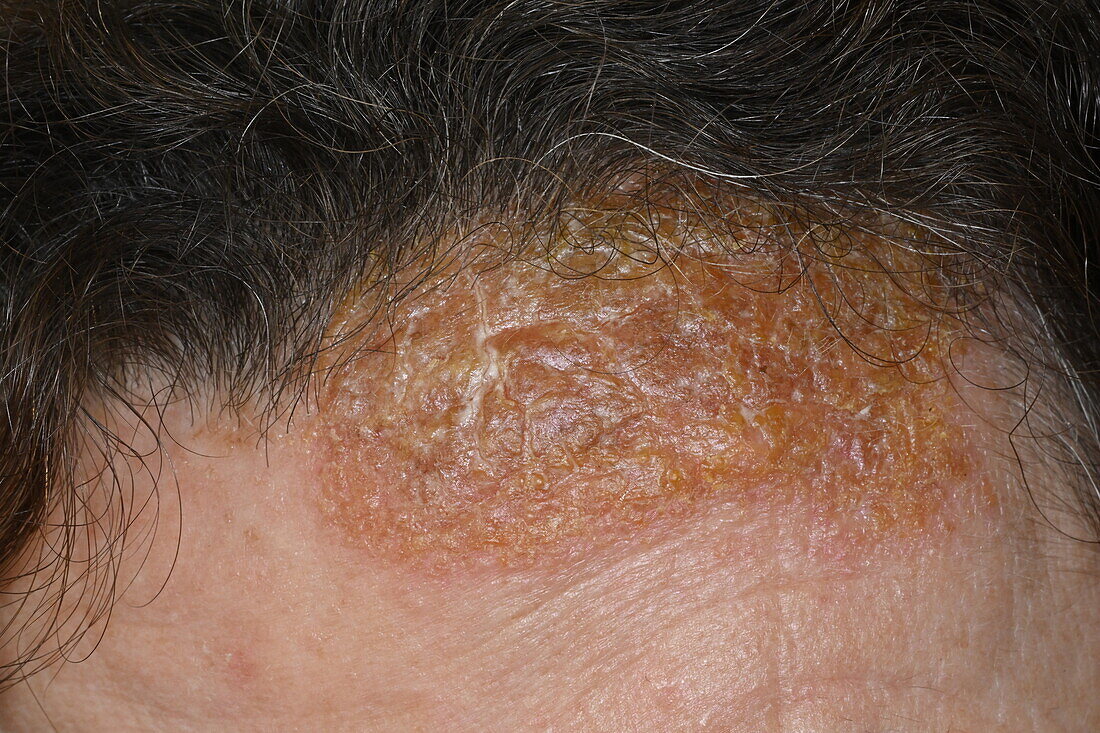 Scarring on a woman's forehead from medication