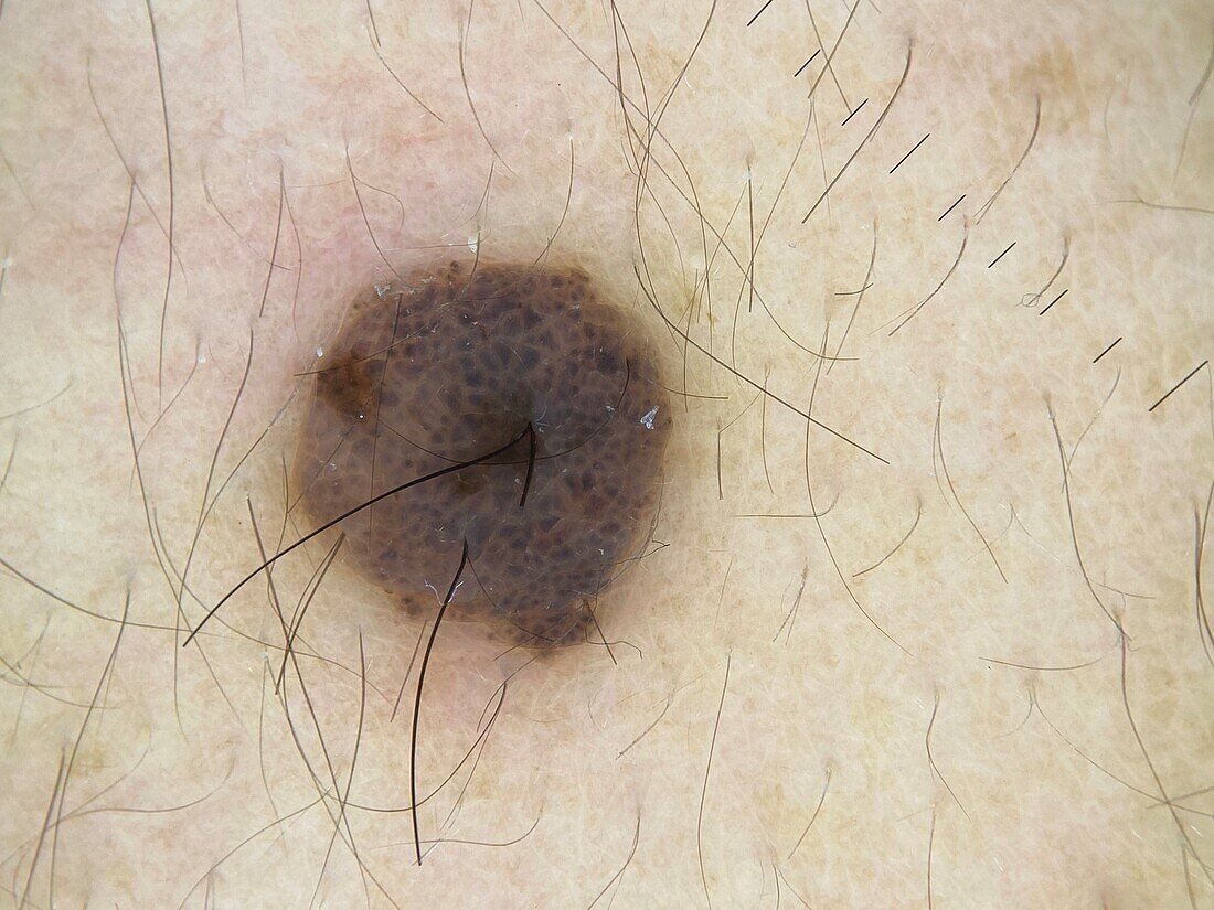 Globules in mole, dermoscopy