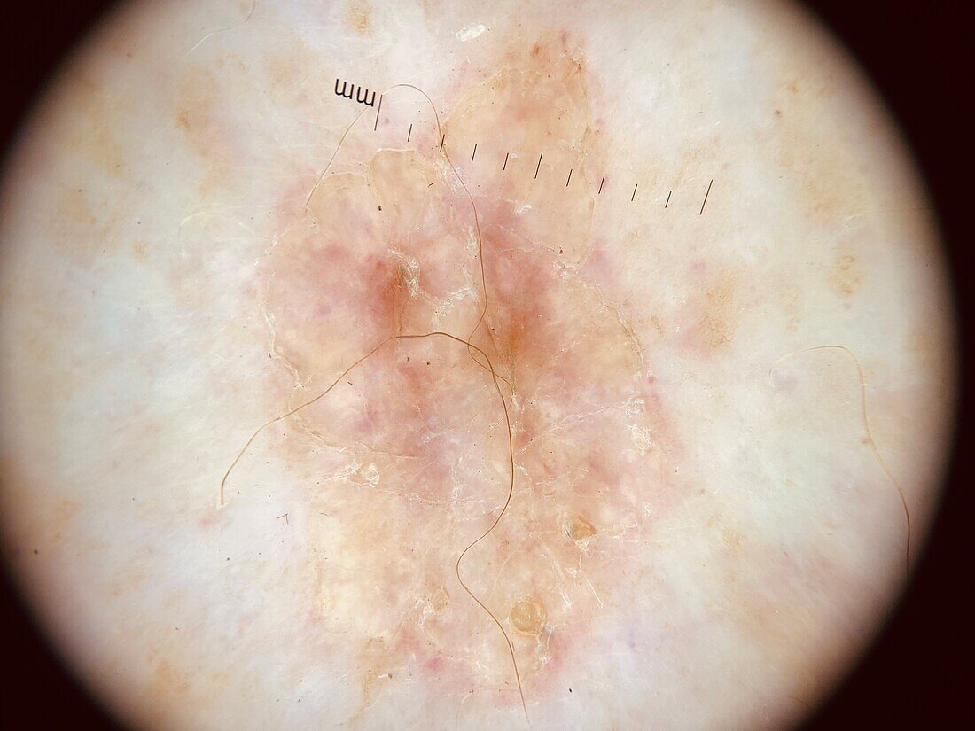 Porokeratosis, dermoscopy