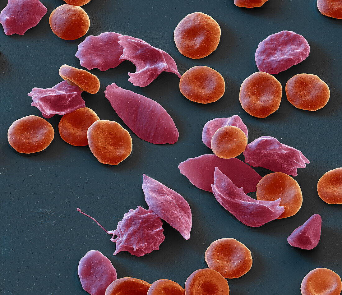 Sickle cell anaemia, SEM