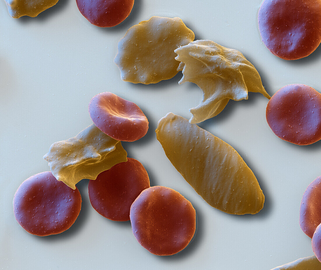 Sickle cell anaemia, SEM