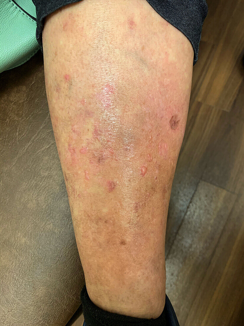 Linear IgA bullous dermatosis