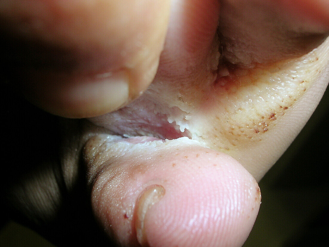 Athlete's foot