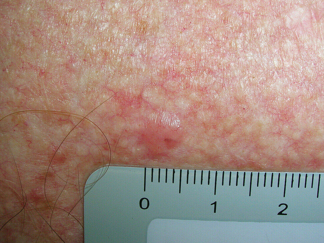 Basal cell carcinoma