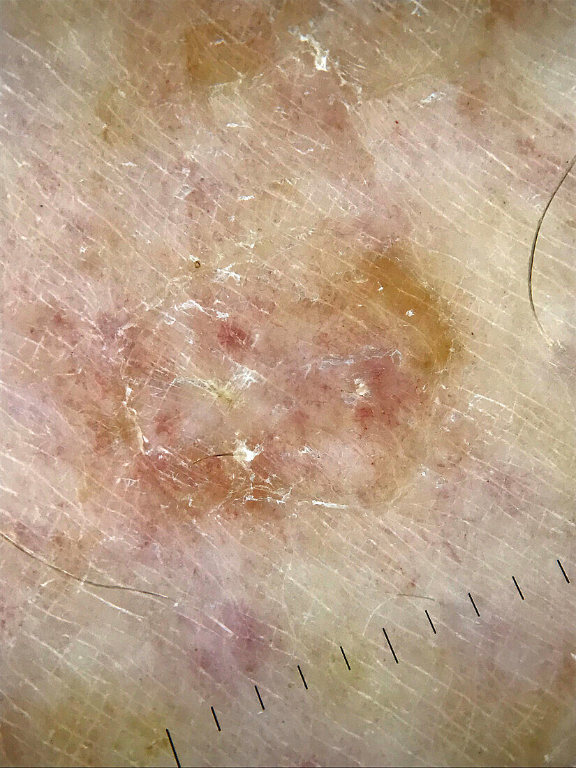 Disseminated superficial actinic porokeratosis, dermoscopy