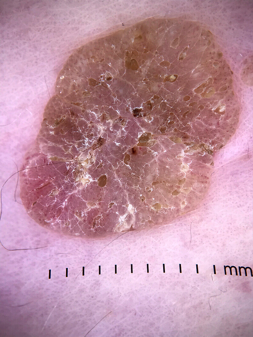 Seborrheic keratosis, dermoscopy