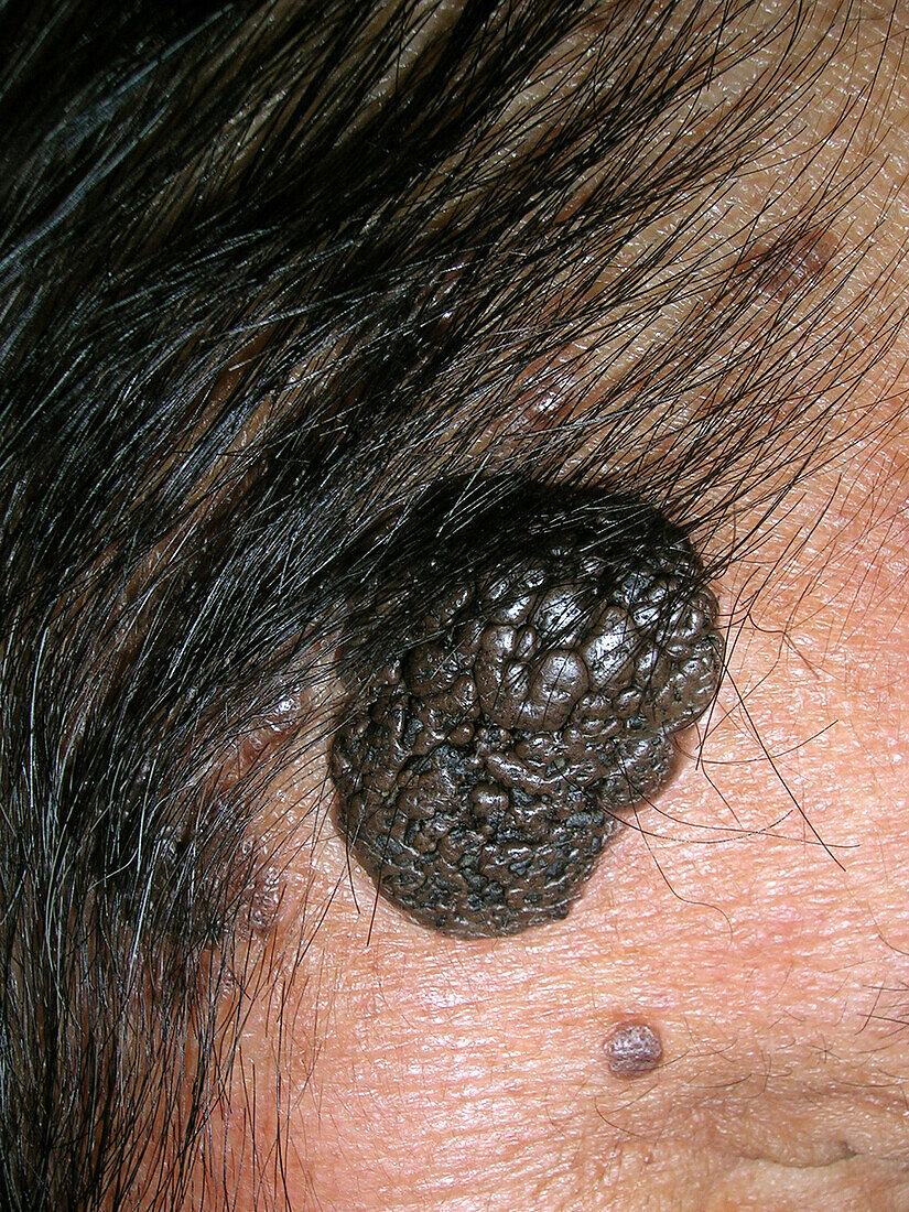 Seborrheic keratosis