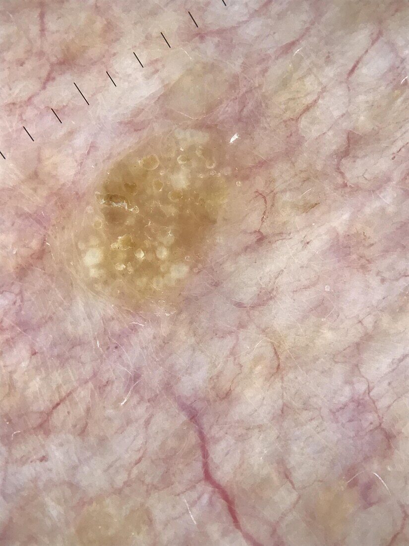 Seborrheic keratosis, dermoscopy