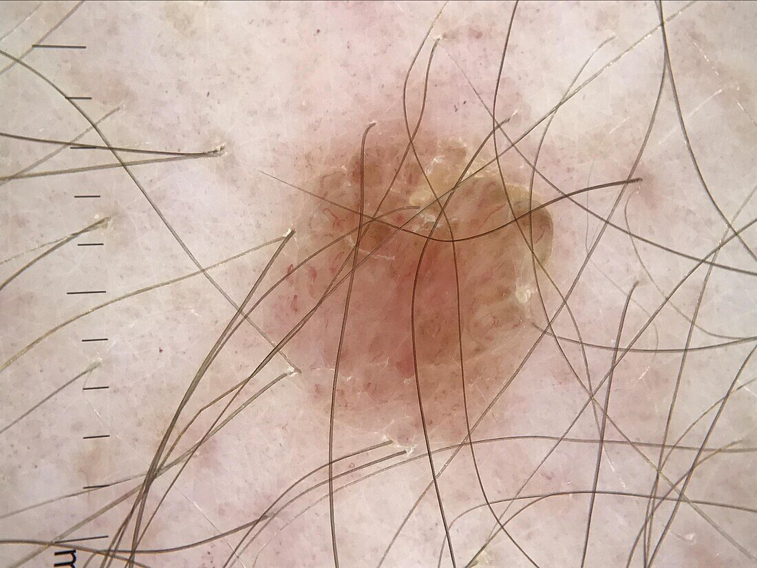 Seborrheic keratosis and intradermal naevus, dermoscopy