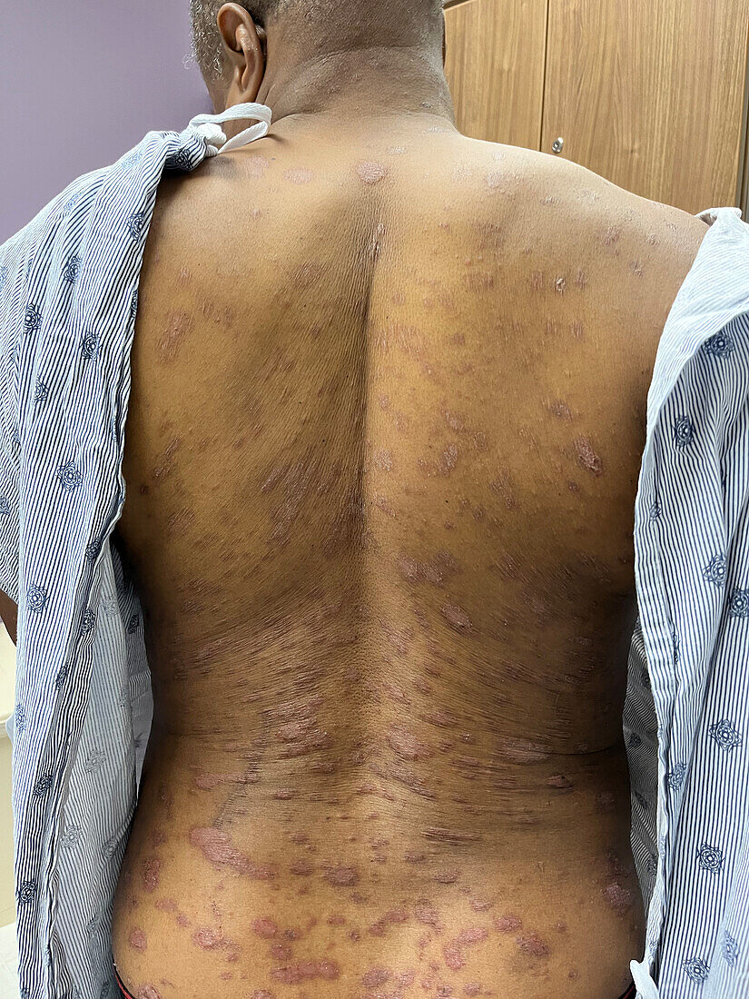 Plaque psoriasis on a man's back