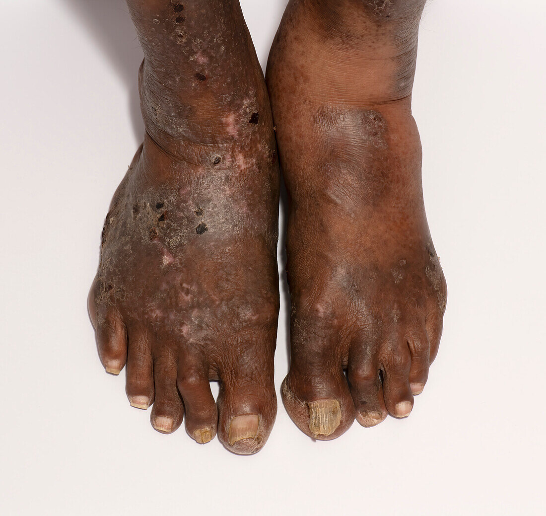 Eczema on a man's feet