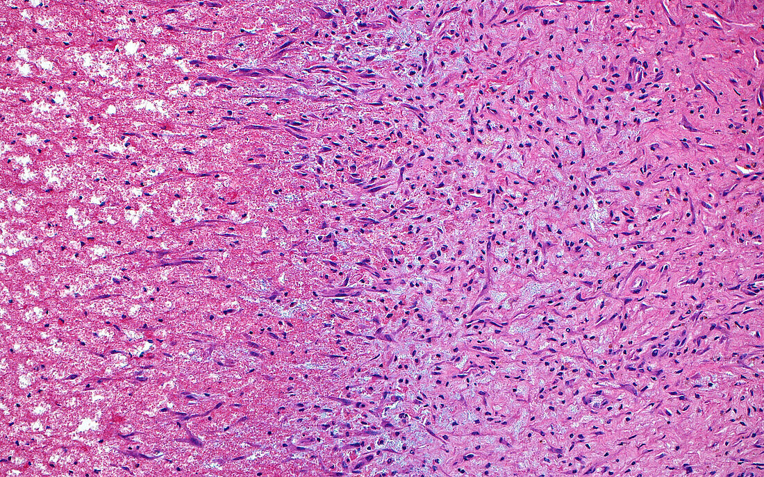 Organising blood clot, light micrograph