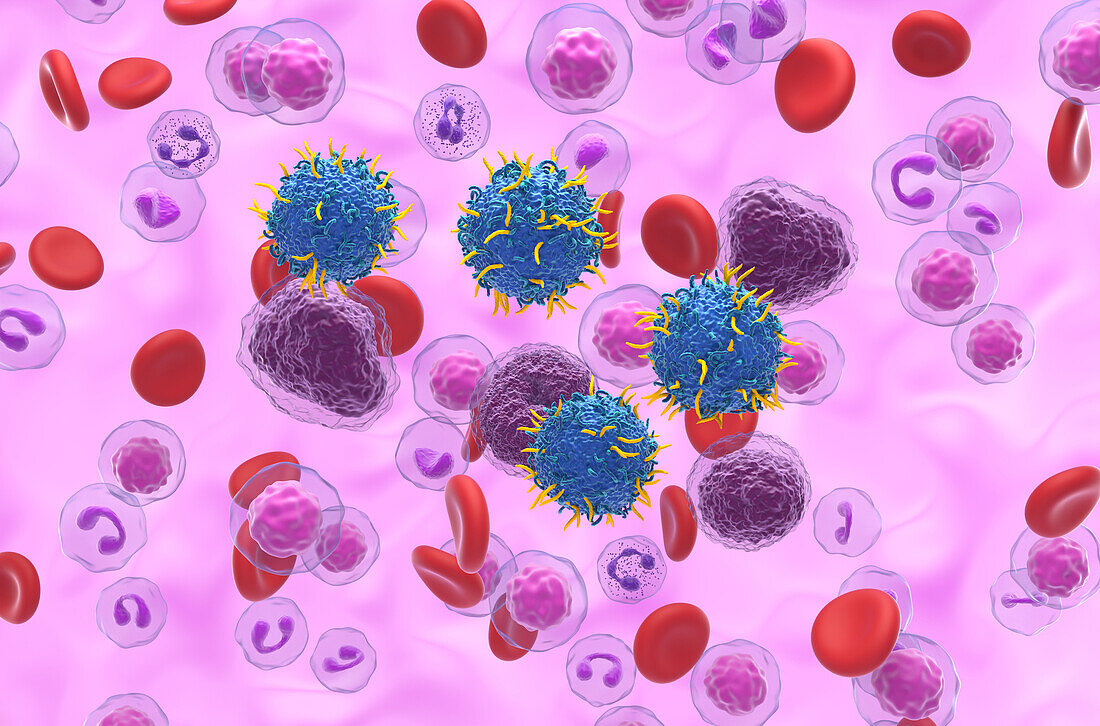 CAR-T cell therapy for non-Hodgkin's lymphoma, illustration