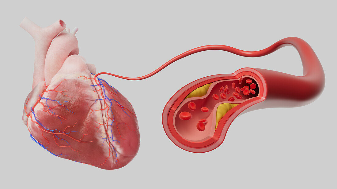 Coronary artery disease, illustration