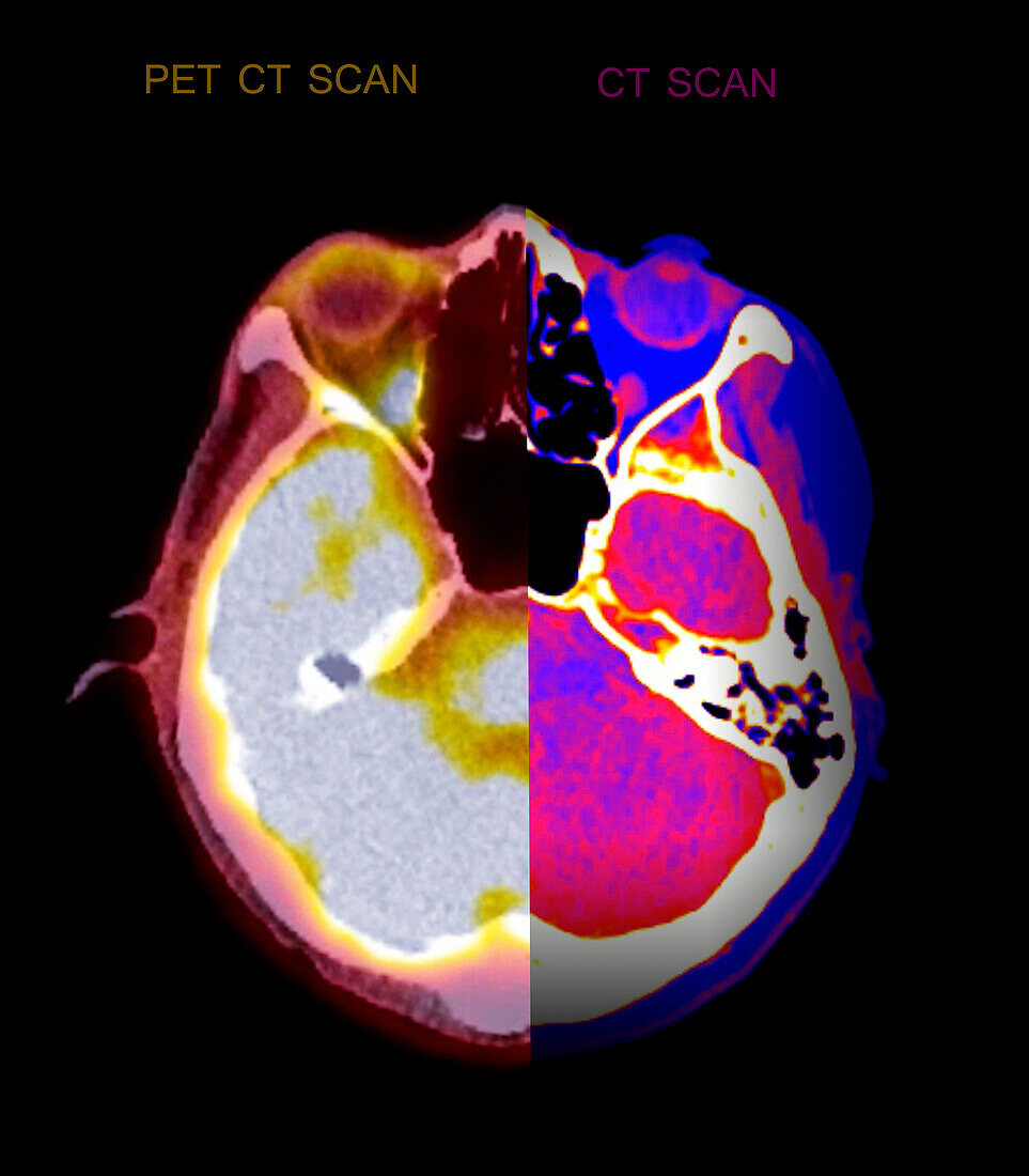 Normal brain, CT-PET and CT scan