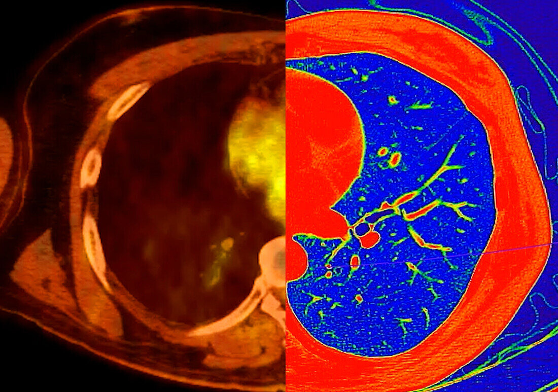 Healthy lungs, CT-PET and CT scan