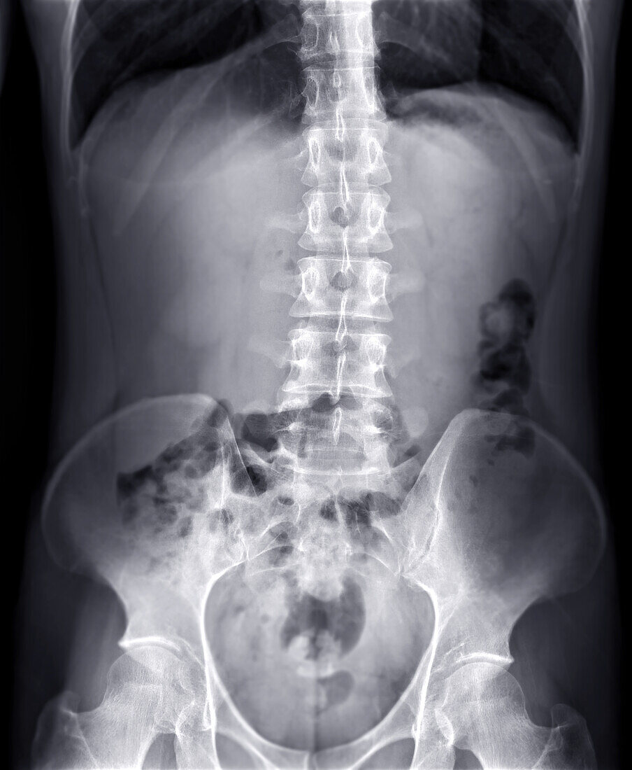 Lumbar spine, X-ray