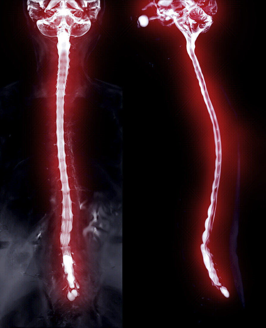 Healthy spinal column, myelogram