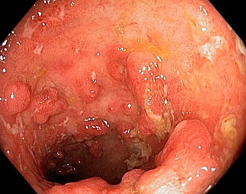 Morbus Crohn Bilder Science Photo Library