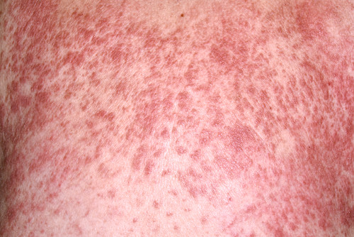 Bullöses Pemphigoid Bilder Science Photo Library