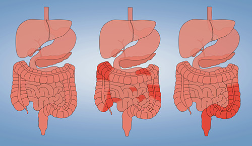 Morbus Crohn Bilder Science Photo Library