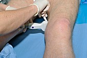 Ultrasound assessment of varicose veins