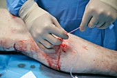 Varicose vein treatment