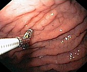 Bacterial stomach infection