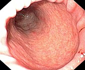 Peristalsis in the stomach
